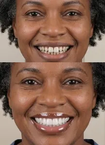 Porcelain Veneers